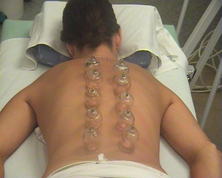 Köpölyözés az egészség megőrzésében tanfolyam